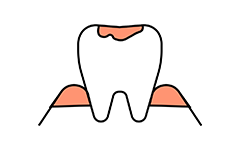 むし歯・歯周病の原因になる
