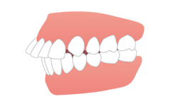 出っ歯(上顎前突)