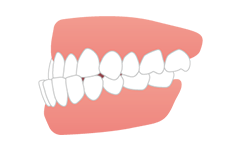 受け口(反対咬合)