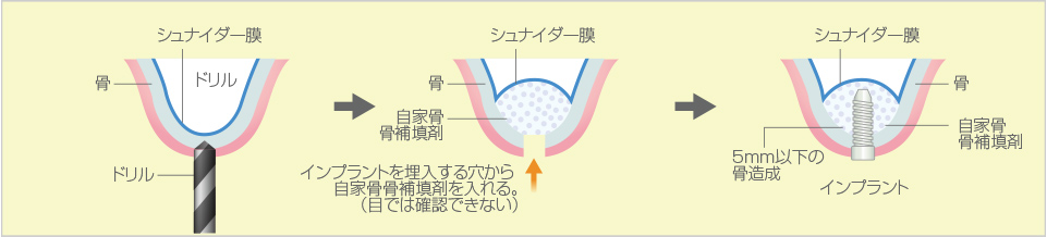 ソケットリフト