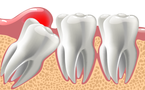 歯茎などの組織への影響