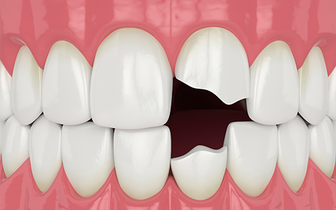 歯の外傷について